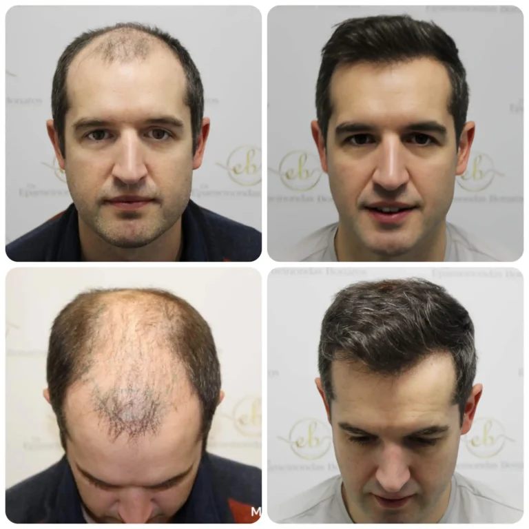 dr-bonaros-12-months-result-hair-transplant-scotland-_7_-768x768